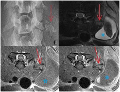 Case report: Focal heterotopic ossification in paravertebral muscles as a cause of neurogenic lameness in a dog